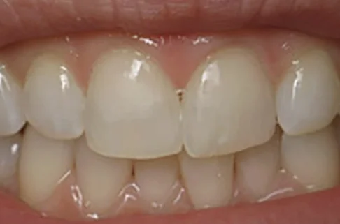 Cosmetic Bonding2-after