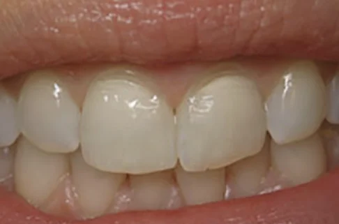 Cosmetic Bonding2-before