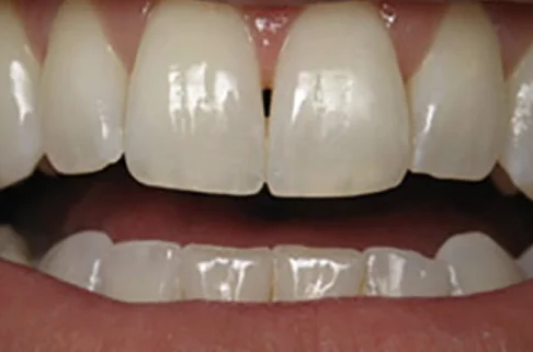 Cosmetic Bonding3-after