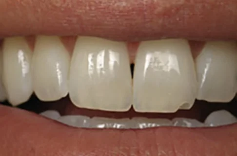 Cosmetic Bonding4-after