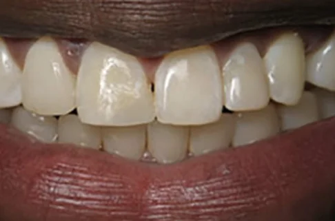 Cosmetic Bonding4-after