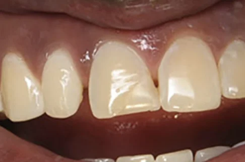 Cosmetic Bonding4-before