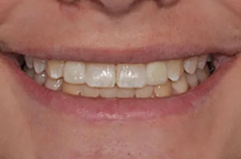 Implants-Implant Restoration-after