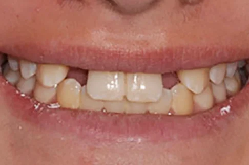 Implants-Implant Restoration-before