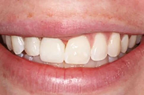 Implants-Implant Restoration2-after