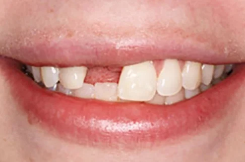 Implants-Implant Restoration2-before