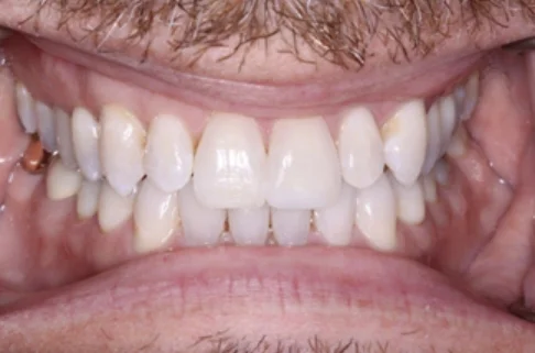 Invisalign2-after