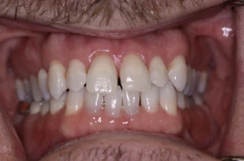 Invisalign2-before