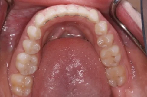 Invisalign3-after