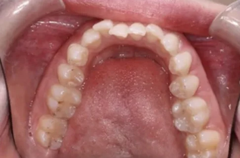 Invisalign3-before