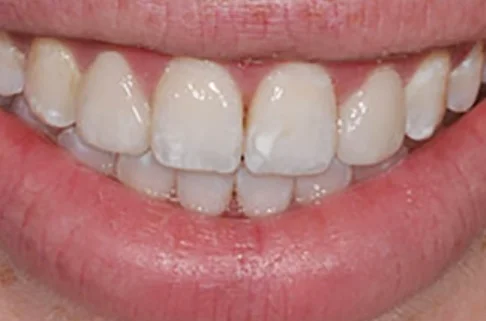 Veneers-after
