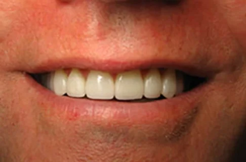 Veneers2-after