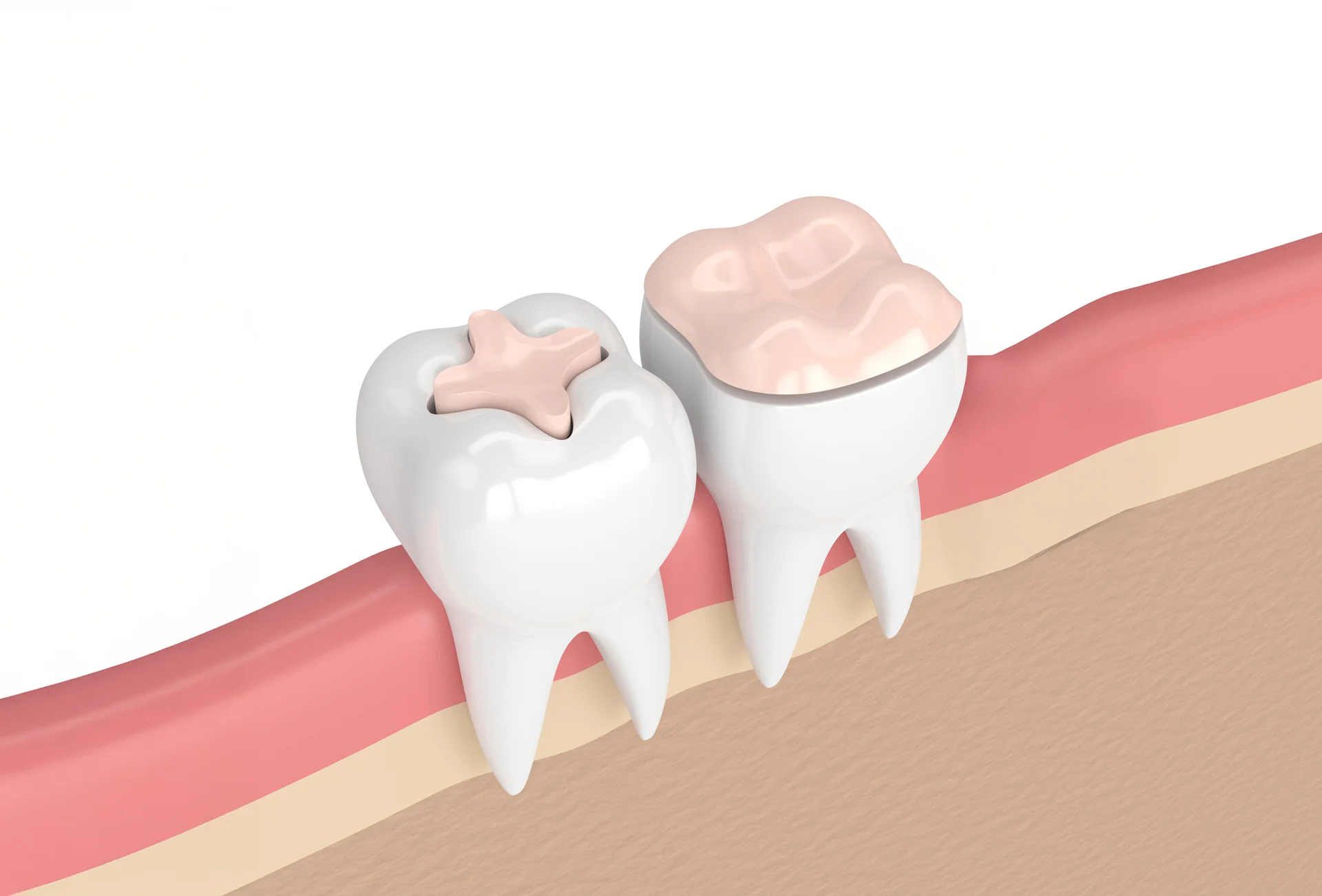Dental Inlays